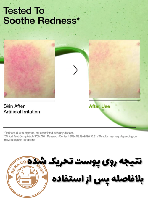 تاثیر سرم آزالئیک اسید آنوا روی قرمزی