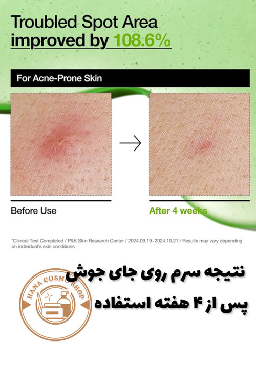 تاثیر سرم آزالئیک اسید آنوا روی جای جوش