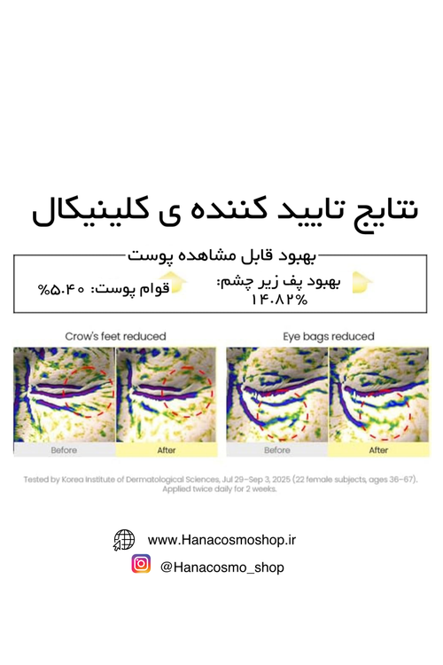 تاثیر قبل و بعد کرم دور چشم رتینال لیپوزوم سئول 1988 کی سکرت