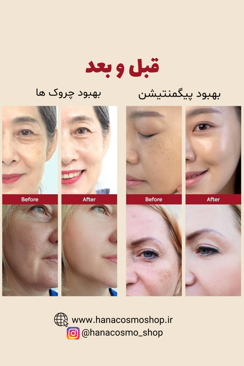 قبل و بعد سرم ضد چروک رتینال لیپوزوم و جینسینگ سیاه سئول 1988 کی سکرت
