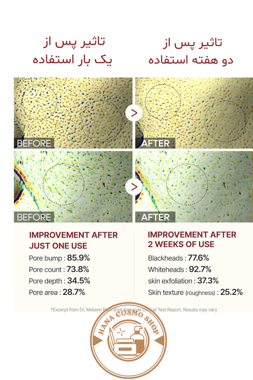 قبل و بعد استفاده از آمپول لایه بردار دکتر ملاکسین