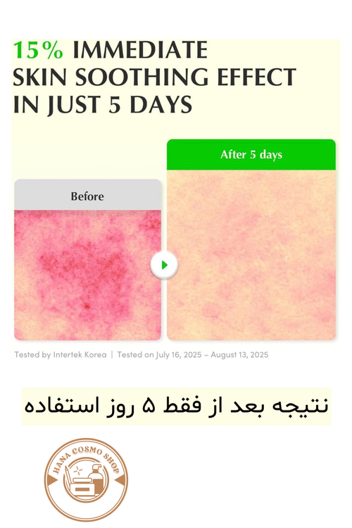 قبل و بعد مصرف سرم تسکین دهنده آلوئه وارا PDRN اکوآل بری